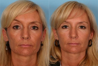 Eyelid Surgery (Blepharoplasty) Before & After Gallery - Patient 562440 - Image 1
