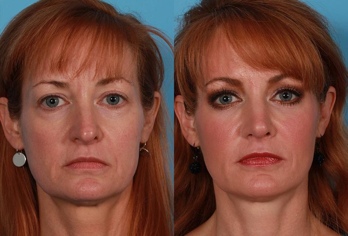 Juvederm Before & After Gallery - Patient 510522 - Image 1