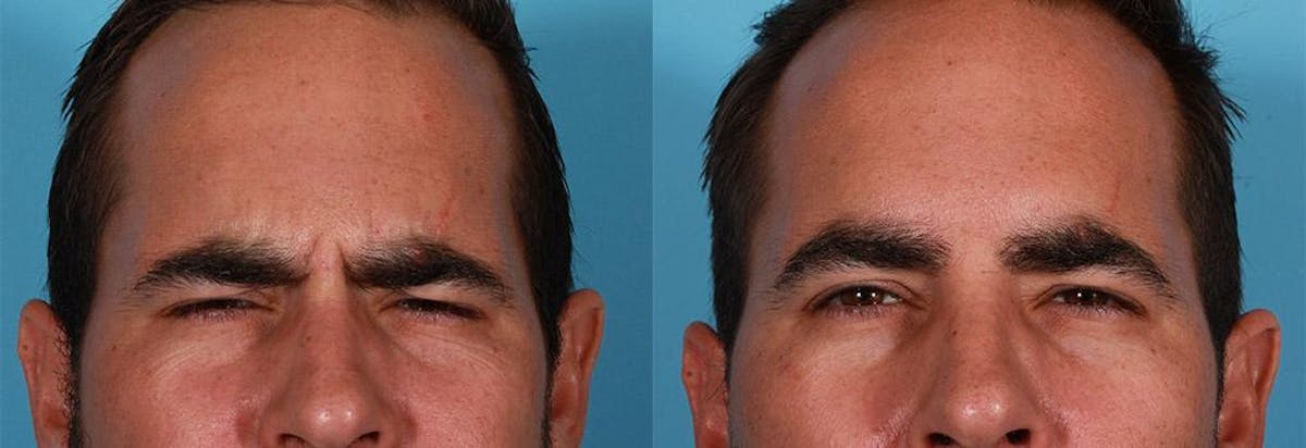 Botox Before & After Gallery - Patient 104943 - Image 3