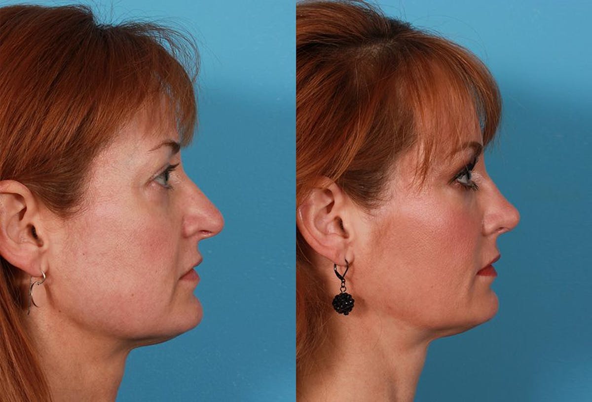 Juvederm Before & After Gallery - Patient 510522 - Image 2