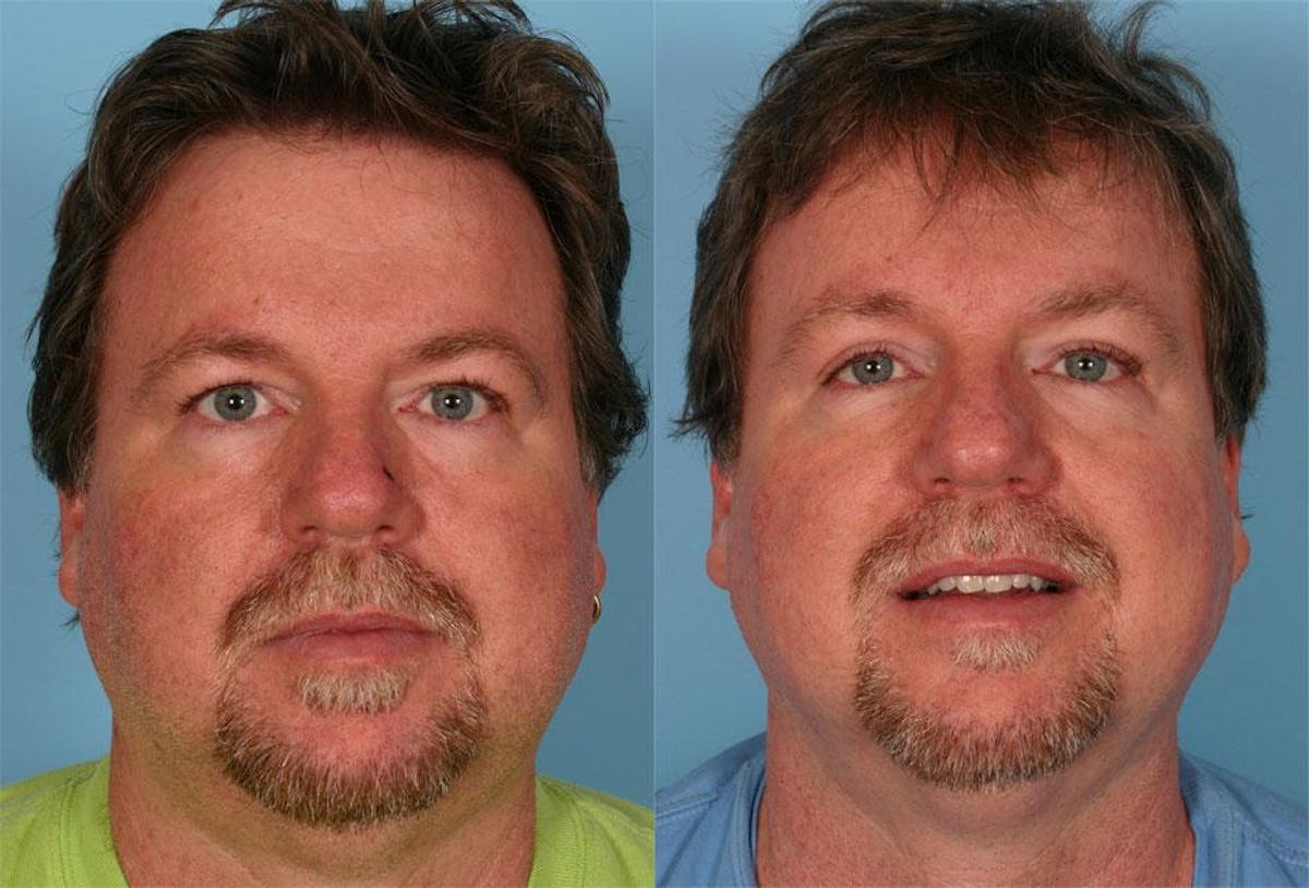 Eyelid Surgery (Blepharoplasty) Before & After Gallery - Patient 351271 - Image 1
