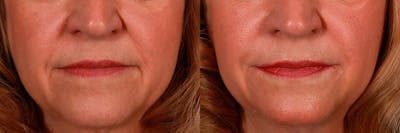 Juvederm Before & After Gallery - Patient 270139 - Image 1