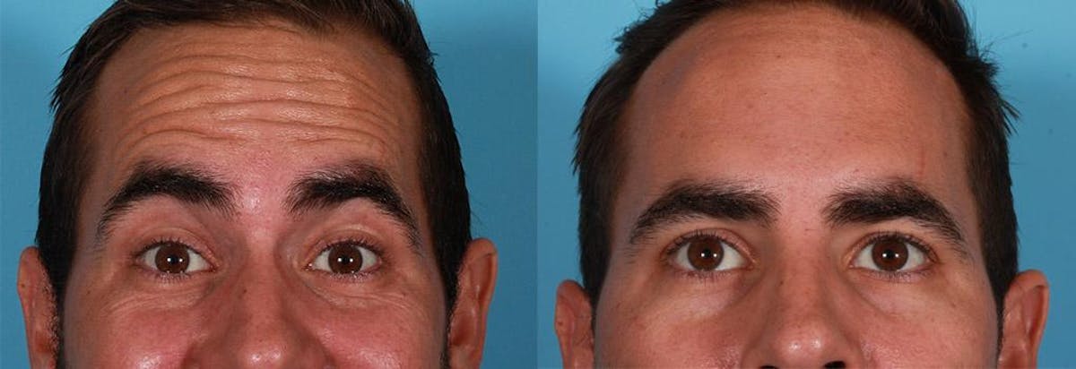 Botox Before & After Gallery - Patient 104943 - Image 6