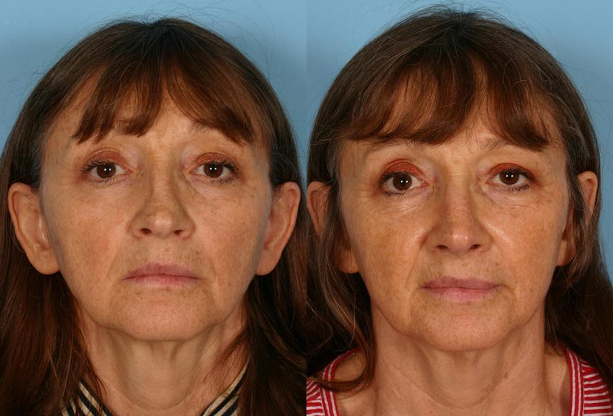 Rhinoplasty Before & After Gallery - Patient 299702 - Image 1