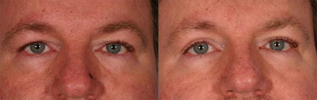 Eyelid Surgery (Blepharoplasty) Before & After Gallery - Patient 351271 - Image 2