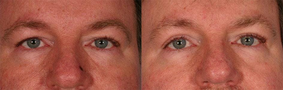 Eyelid Surgery (Blepharoplasty) Before & After Gallery - Patient 351271 - Image 2