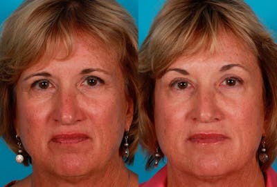 Juvederm Before & After Gallery - Patient 240514 - Image 1