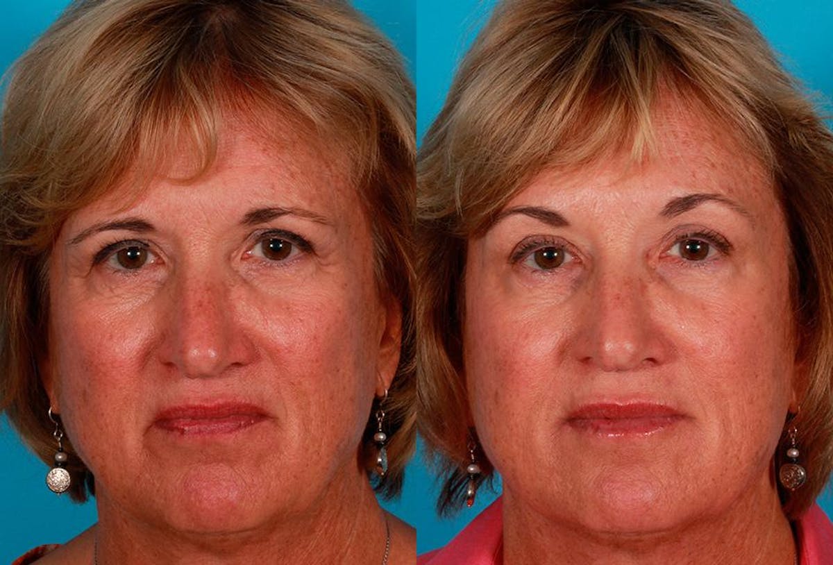 Juvederm Before & After Gallery - Patient 240514 - Image 1
