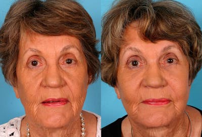 Facelift Before & After Gallery - Patient 205566 - Image 1