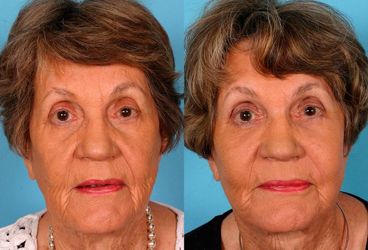 Facelift Before & After Gallery - Patient 205566 - Image 1