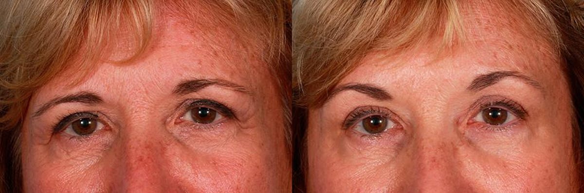 Juvederm Before & After Gallery - Patient 240514 - Image 2