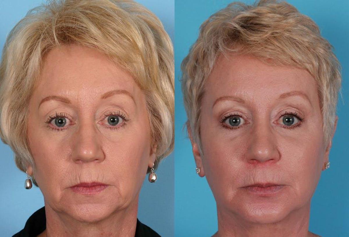 Facial Fat Transfer Before & After Gallery - Patient 138939 - Image 1