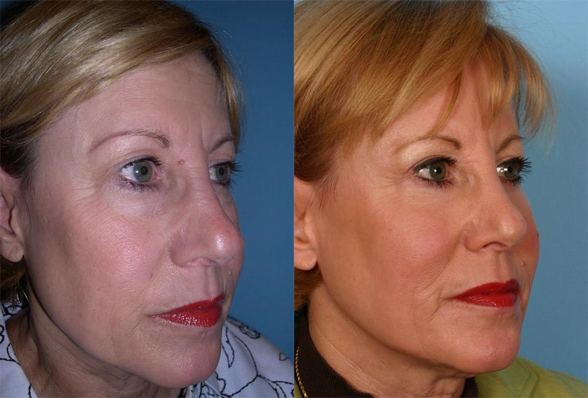 TCA Peel / Dermabrasion Before & After Gallery - Patient 320810 - Image 2
