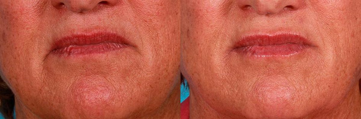 Juvederm Before & After Gallery - Patient 240514 - Image 3