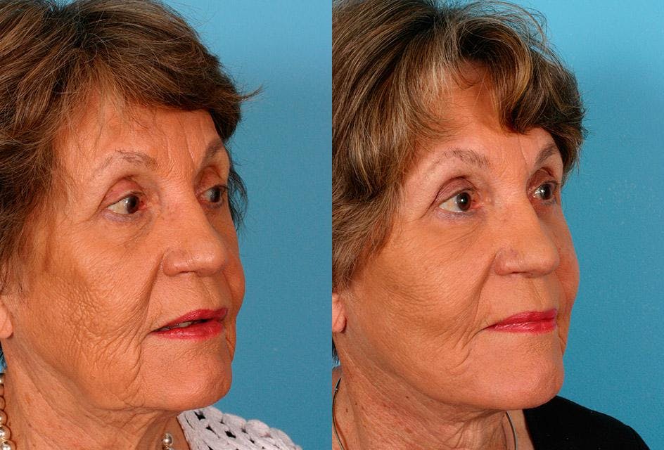 Facelift Before & After Gallery - Patient 205566 - Image 2