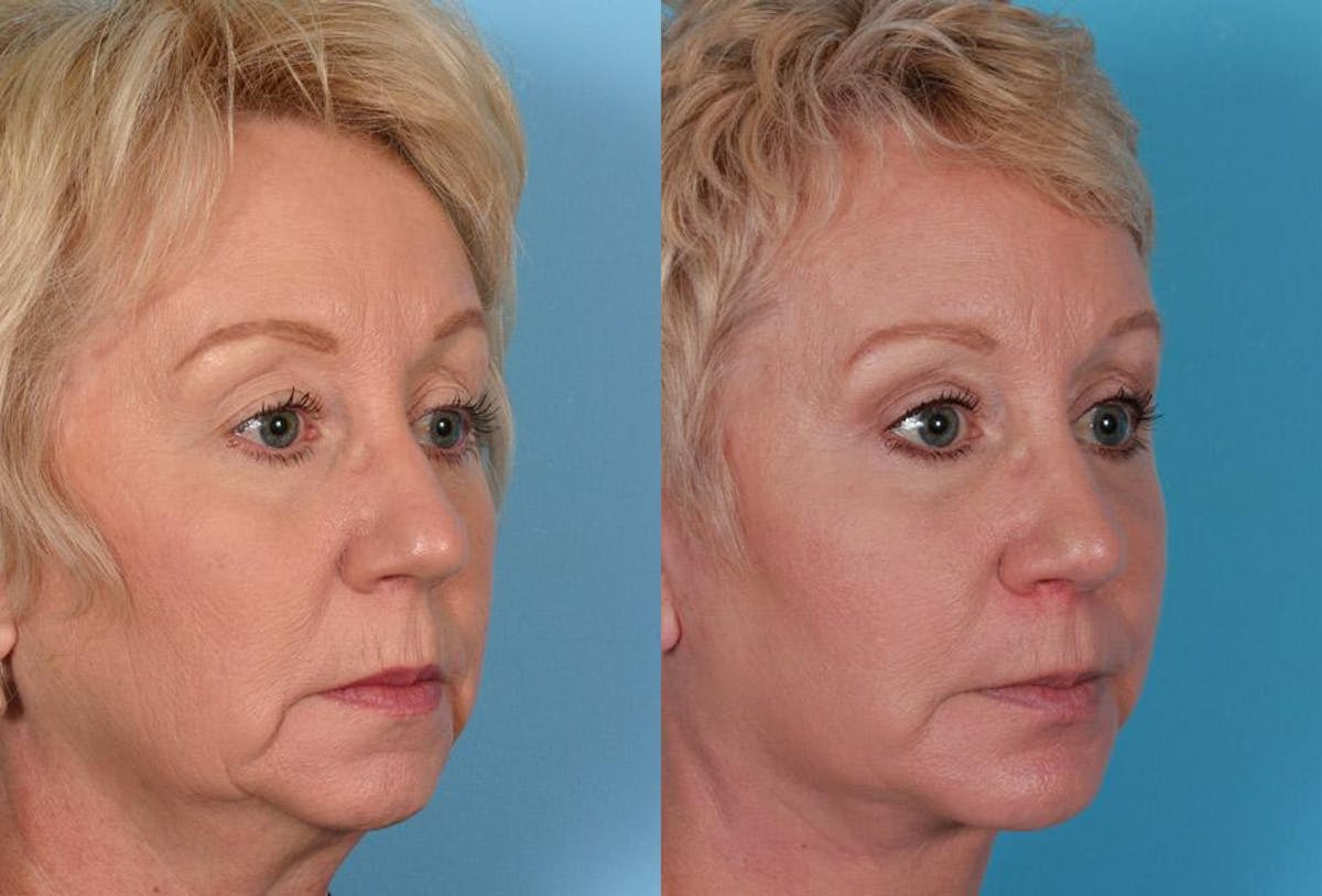 Facial Fat Transfer Before & After Gallery - Patient 138939 - Image 2