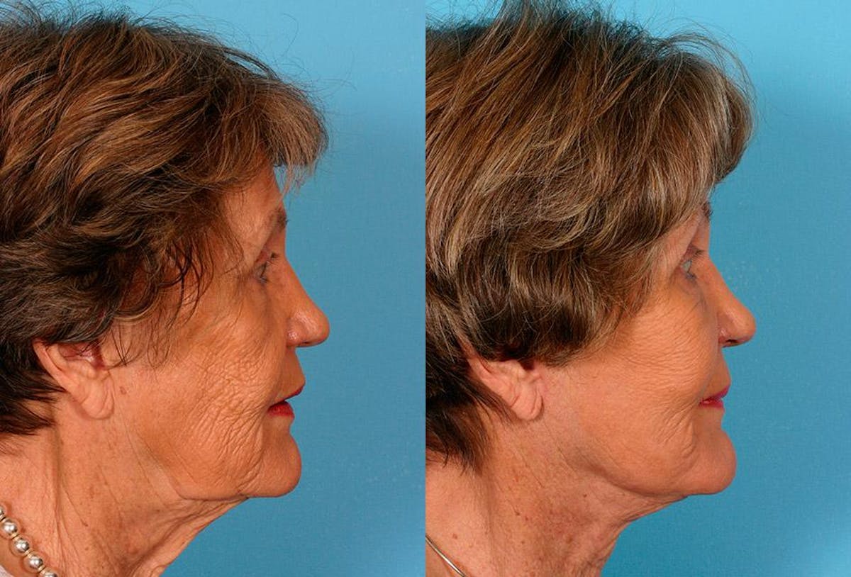 Facelift Before & After Gallery - Patient 205566 - Image 3