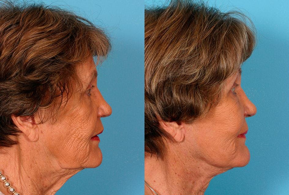 Facelift Before & After Gallery - Patient 205566 - Image 3