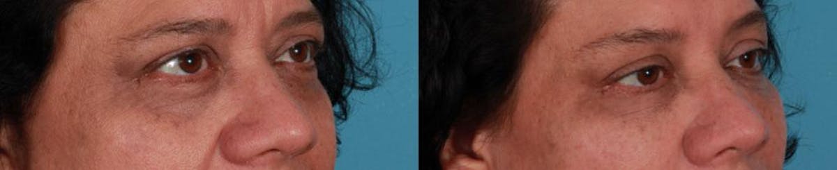 Botox Before & After Gallery - Patient 396159 - Image 2