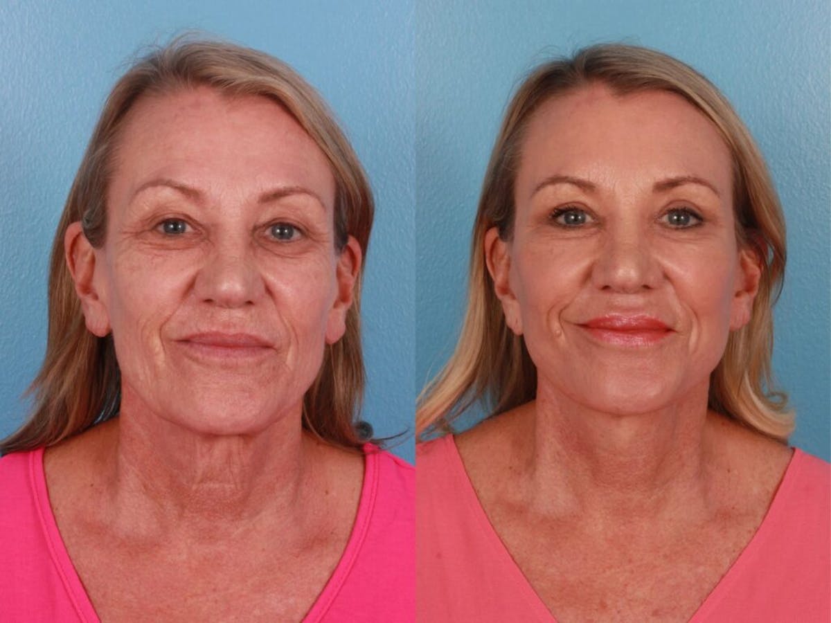 Limited Incision Facelift Before & After Gallery - Patient 159280 - Image 2