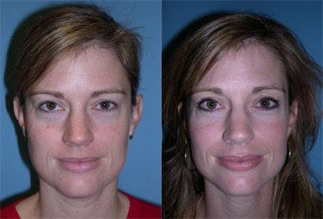 TCA Peel / Dermabrasion Before & After Gallery - Patient 326529 - Image 1