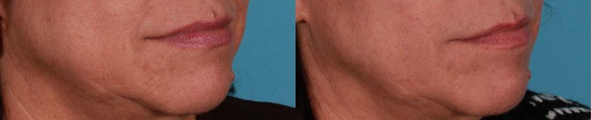 Botox Before & After Gallery - Patient 396159 - Image 3