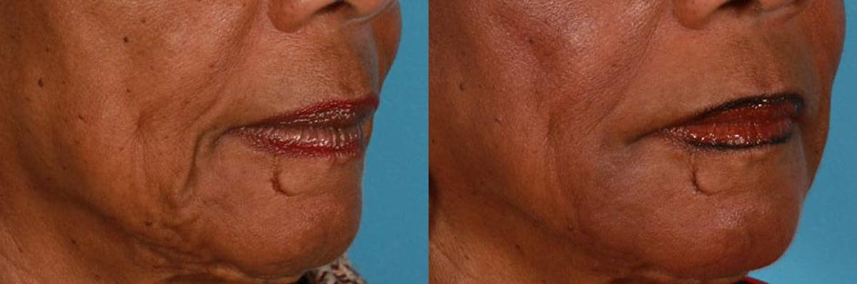 Juvederm Before & After Gallery - Patient 308267 - Image 2