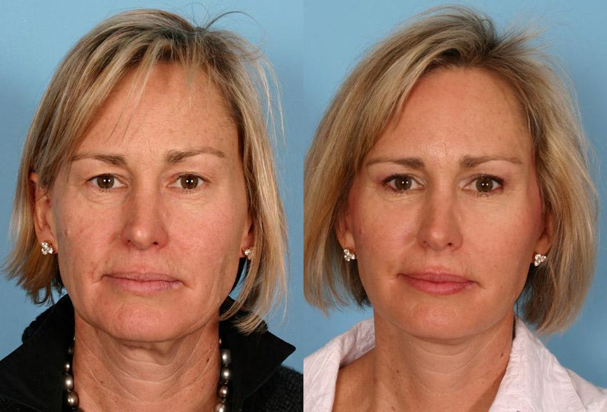 Facial Fat Transfer Before & After Gallery - Patient 816527 - Image 1