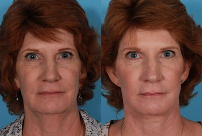 Facelift Before & After Gallery - Patient 179100 - Image 1