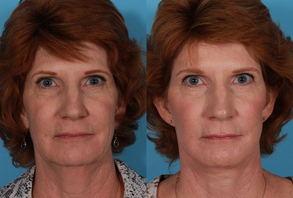 Facelift Before & After Gallery - Patient 179100 - Image 1