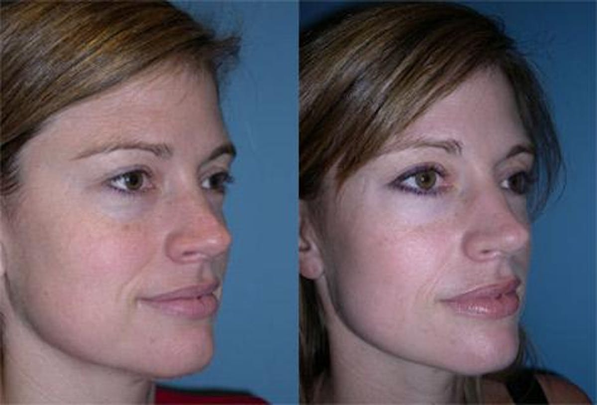 TCA Peel / Dermabrasion Before & After Gallery - Patient 326529 - Image 2