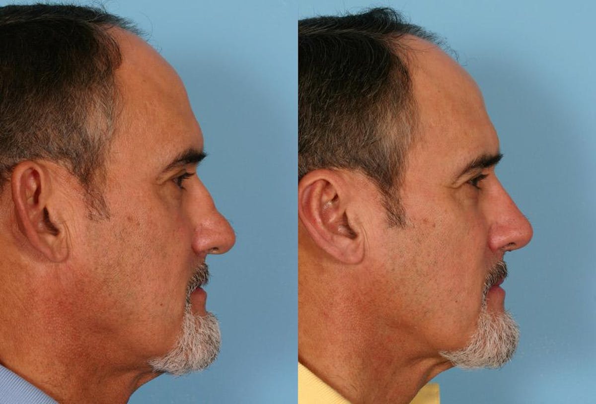 Rhinoplasty Before & After Gallery - Patient 244130 - Image 2