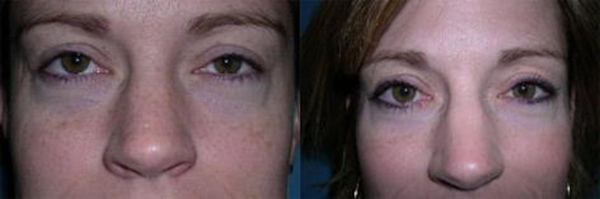 TCA Peel / Dermabrasion Before & After Gallery - Patient 326529 - Image 3