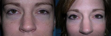 TCA Peel / Dermabrasion Before & After Gallery - Patient 326529 - Image 3