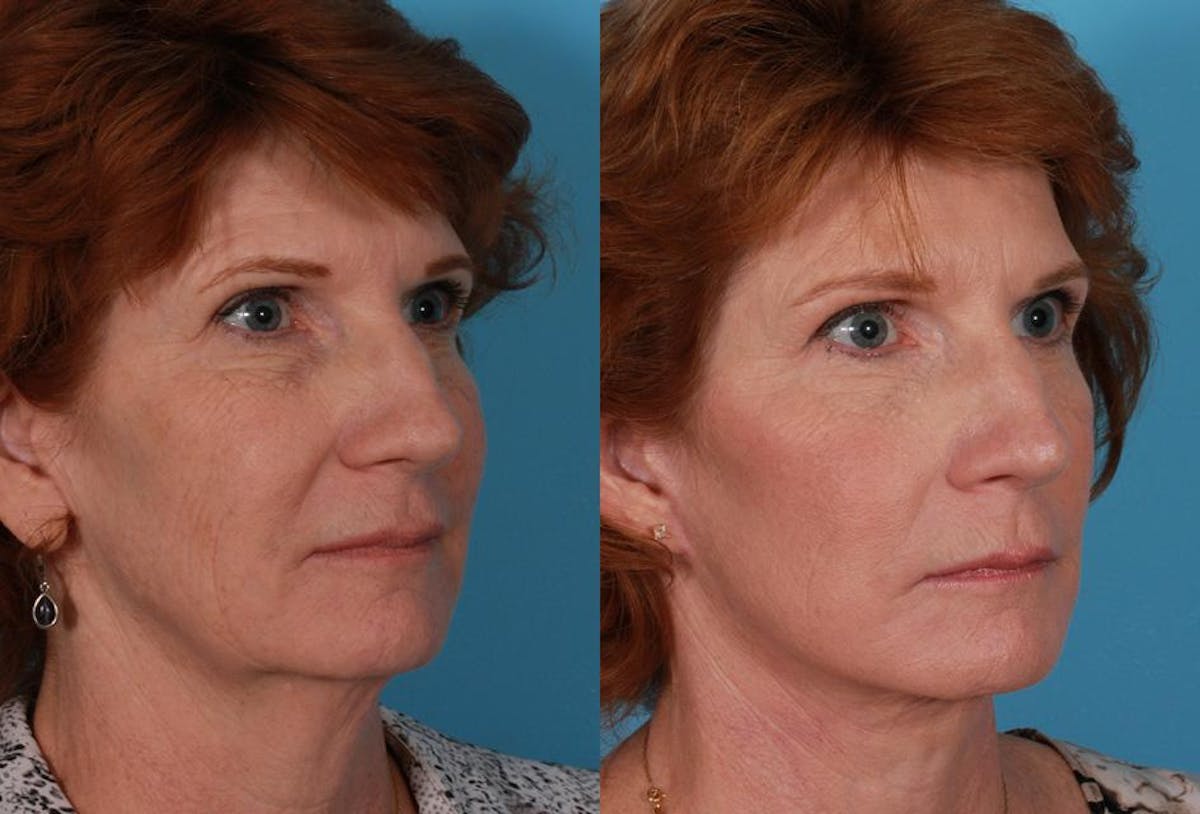 Facelift Before & After Gallery - Patient 179100 - Image 2