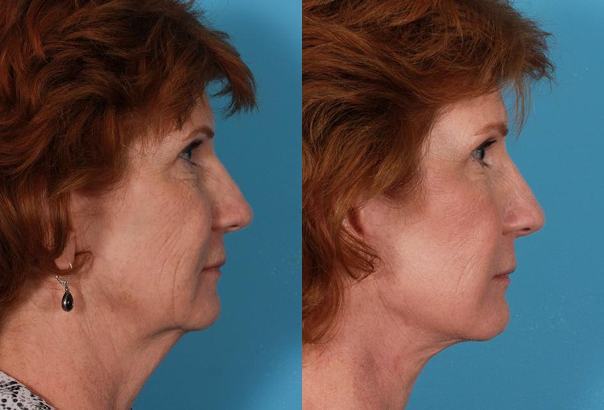 Facelift Before & After Gallery - Patient 179100 - Image 3