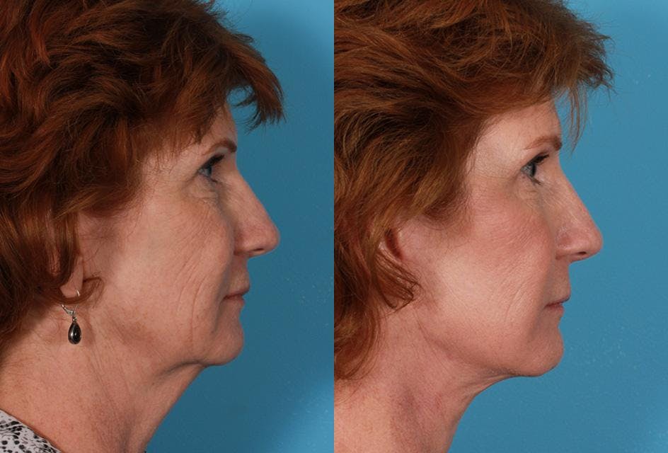Facelift Before & After Gallery - Patient 179100 - Image 3