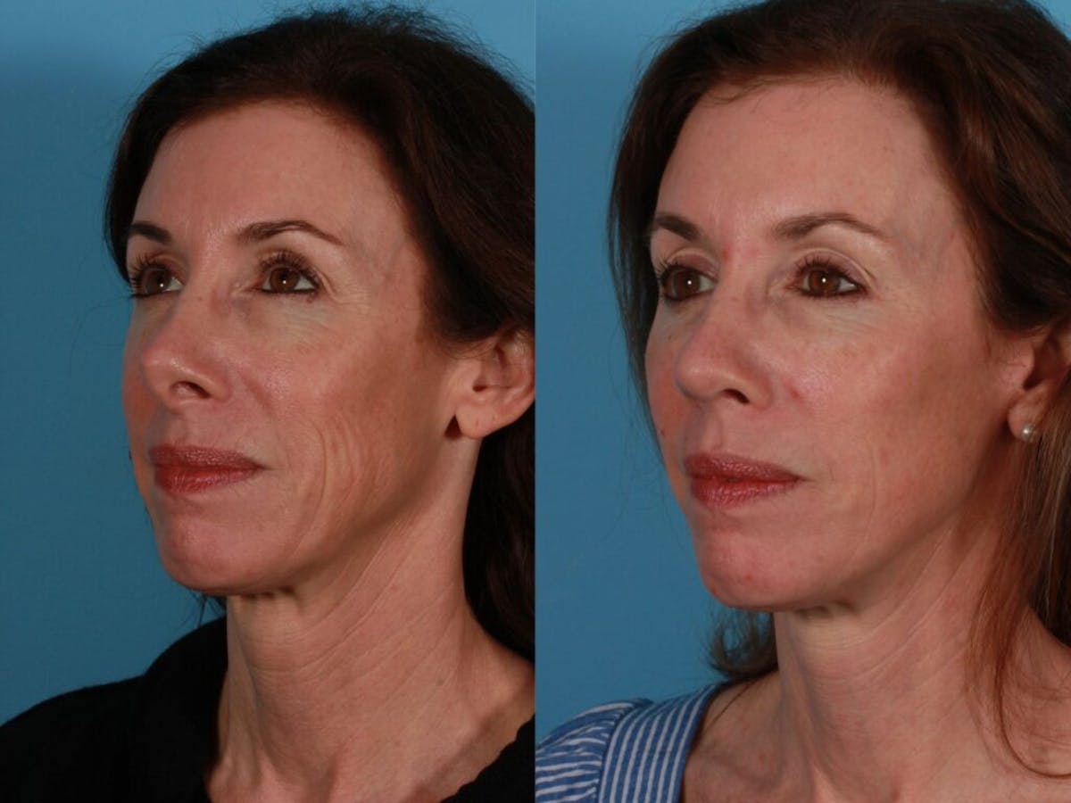 Limited Incision Facelift Before & After Gallery - Patient 421375 - Image 2