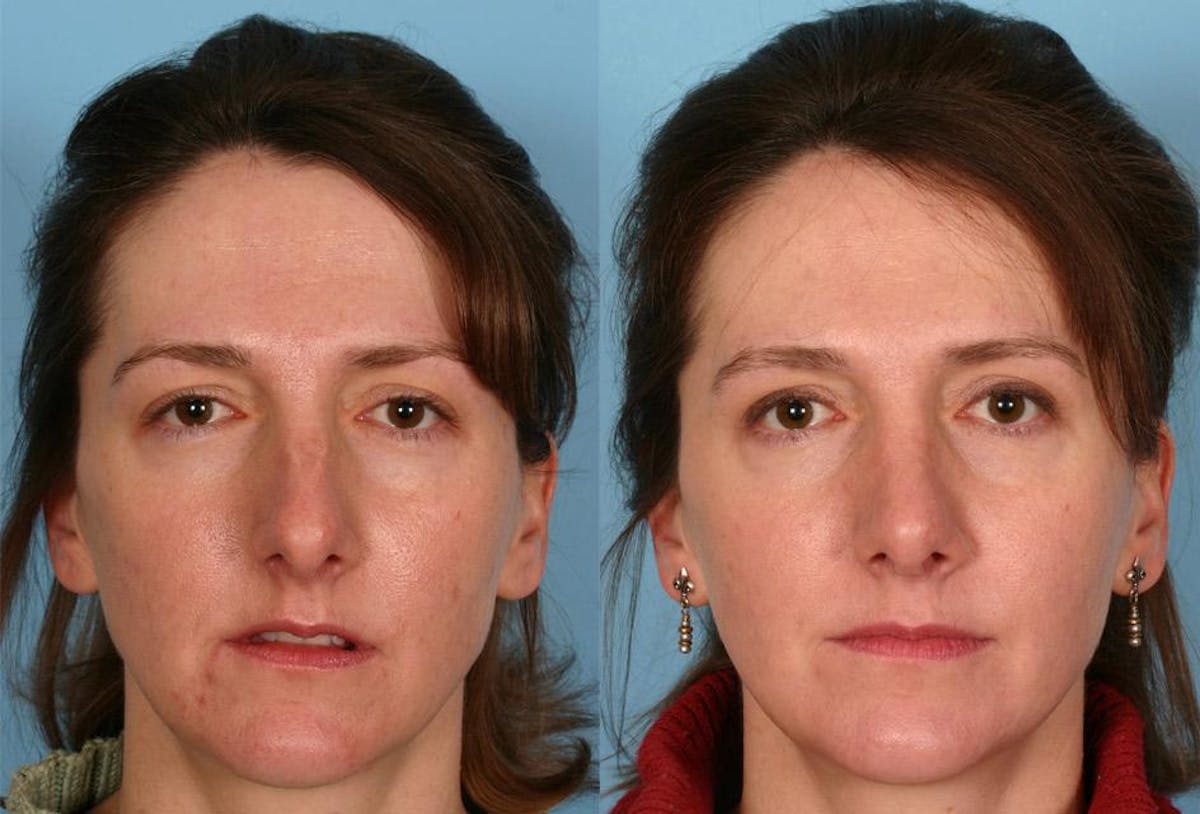 Rhinoplasty Before & After Gallery - Patient 223622 - Image 1