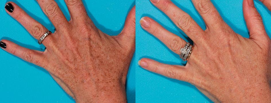 Lasers Before & After Gallery - Patient 316419 - Image 2