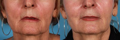 Juvederm Before & After Gallery - Patient 129224 - Image 1