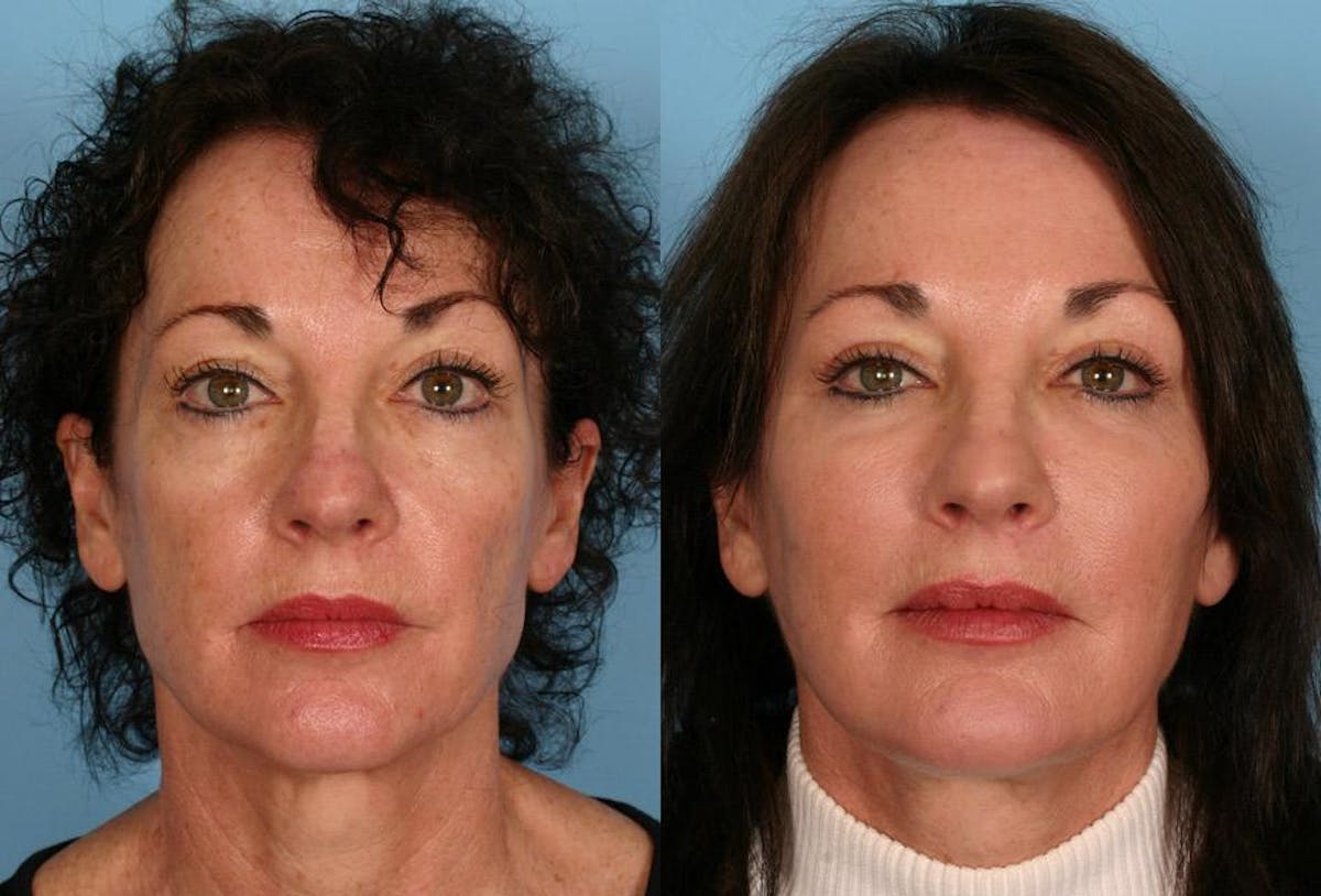 Facial Fat Transfer Before & After Gallery - Patient 306425 - Image 1