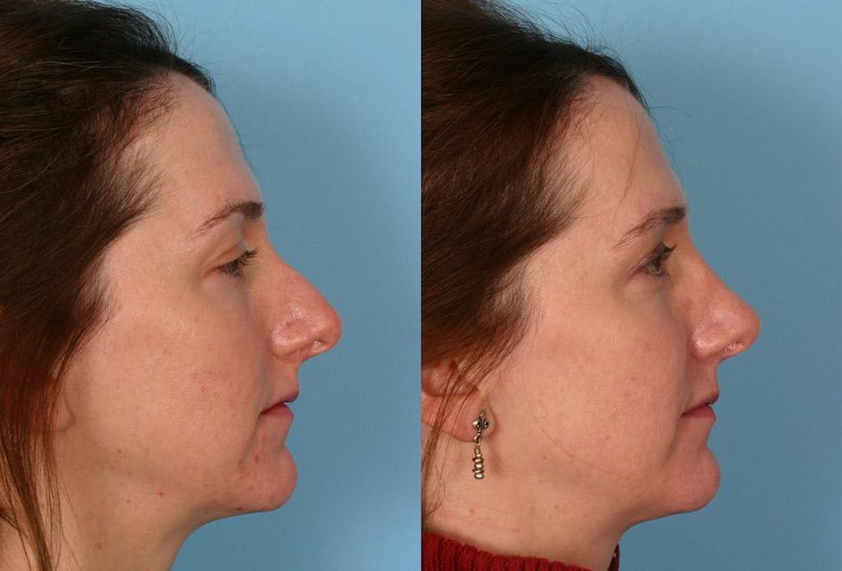 Rhinoplasty Before & After Gallery - Patient 223622 - Image 2