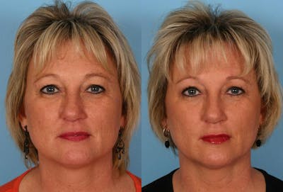 Lip Augmentation Before & After Gallery - Patient 312119 - Image 1