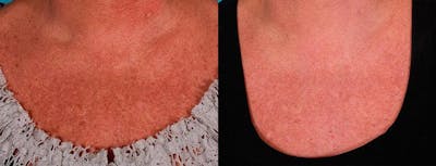 Lasers Before & After Gallery - Patient 322768 - Image 1