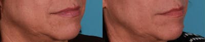 Juvederm Before & After Gallery - Patient 236655 - Image 1