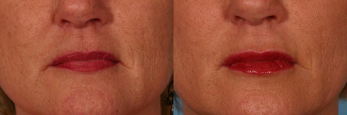 Lip Augmentation Before & After Gallery - Patient 312119 - Image 2