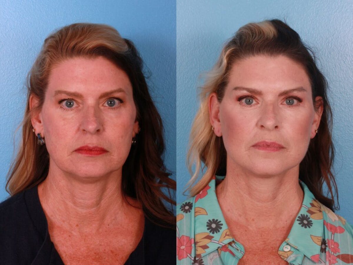Limited Incision Facelift Before & After Gallery - Patient 100018 - Image 1