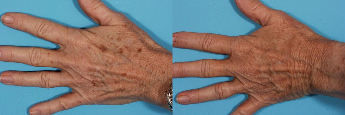 Lasers Before & After Gallery - Patient 401193 - Image 1