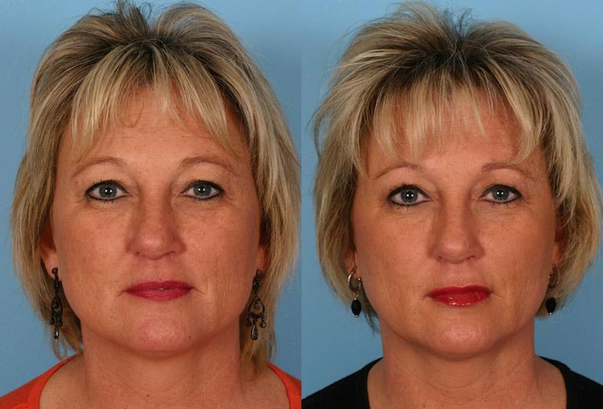 Lip Augmentation Before & After Gallery - Patient 312119 - Image 3